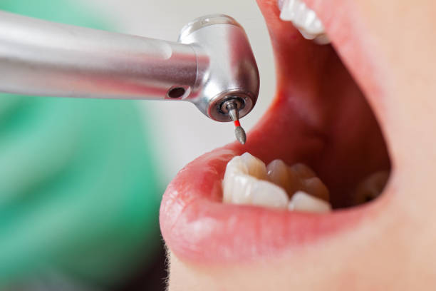 Best Emergency Treatment for Dental Infections or Abscesses in Gunnison, CO